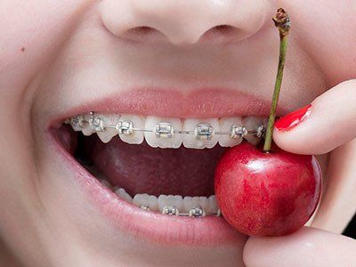 apparecchio denti