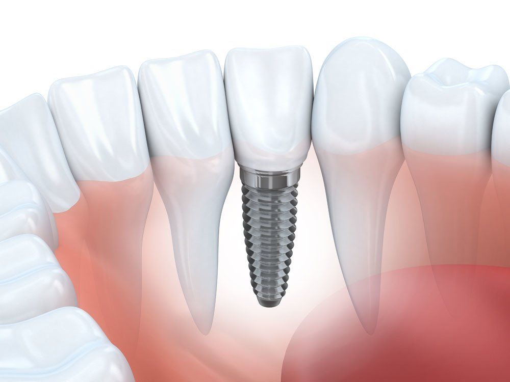 immagine 3d impianto dentale a carico immediato