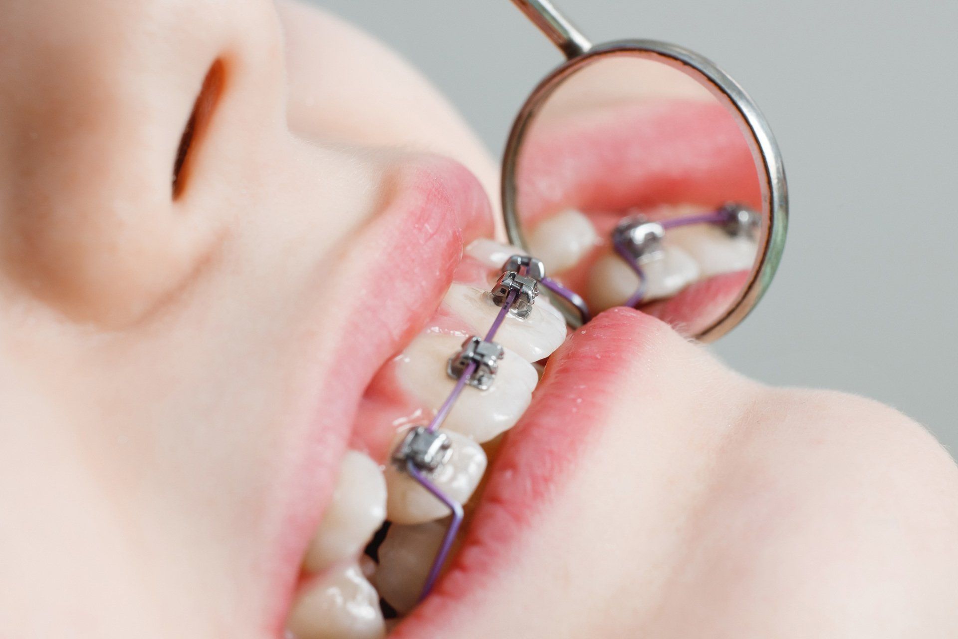 apparecchio fisso denti