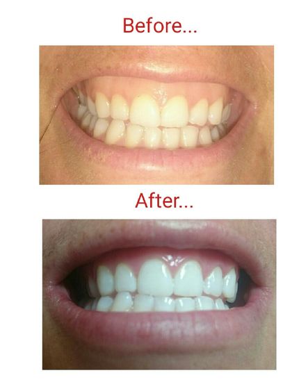 10 shades whiter teeth