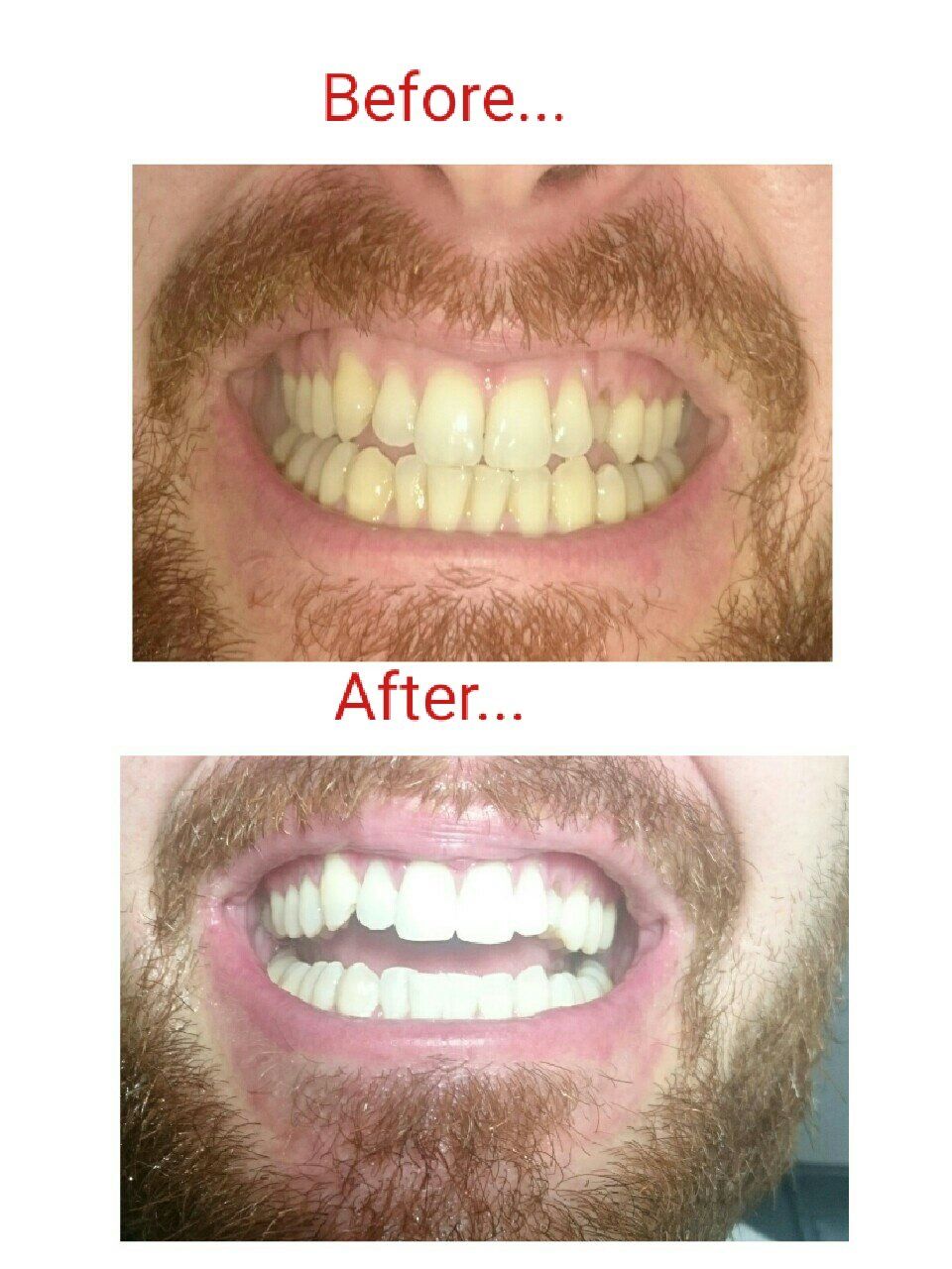 before and after teeth whitening