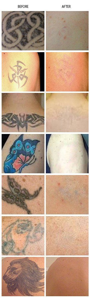 Laser Tattoo Removal