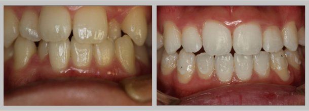 Before/After
