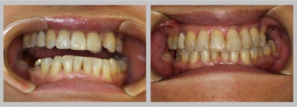 Braces: Before/After