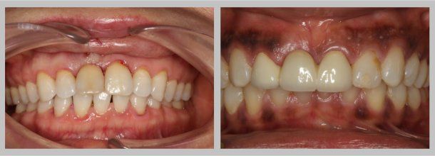 Bridge: Before/After