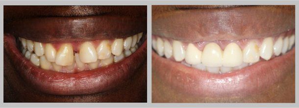 Before/After
