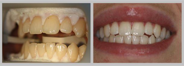 Whitening