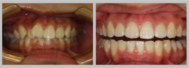 Braces