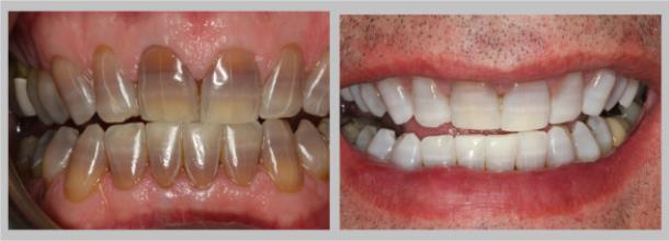 Kor Deep Whitening: Before/After