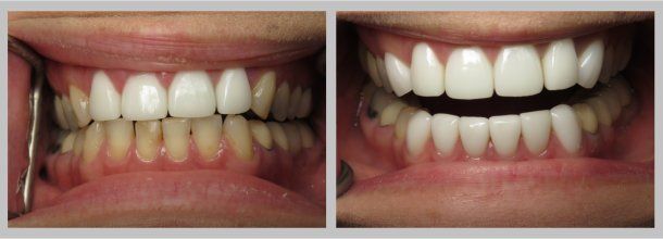 Before/After