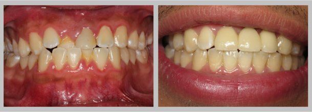 Before/After