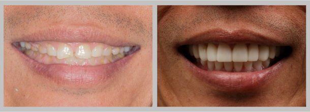 Before/After