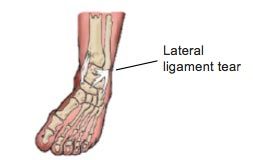 sprain diagram
