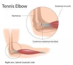 tennis elbow