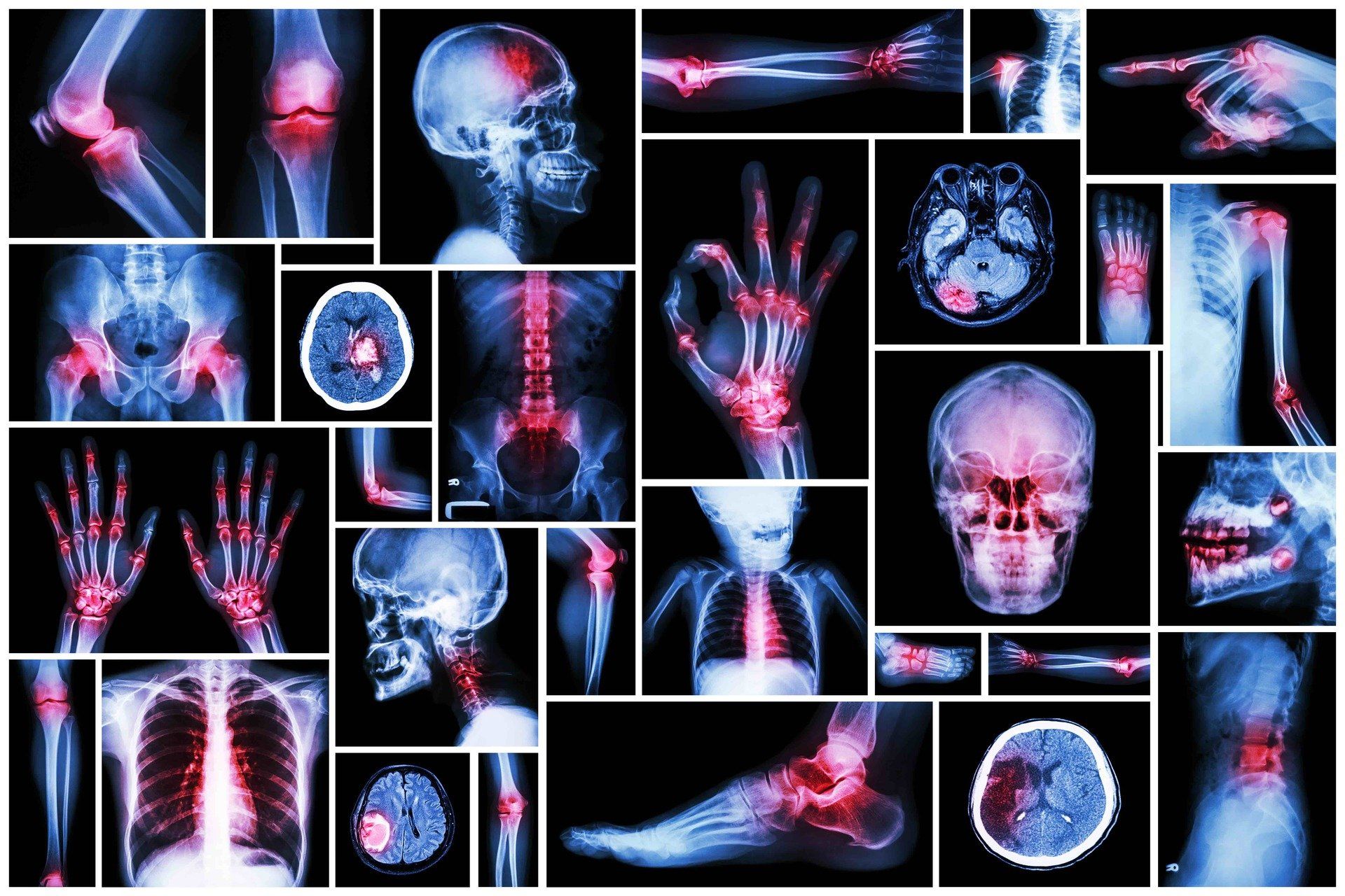 Arthritis Bristol