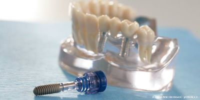 Zertifizierte Implantate renommierter Hersteller Zertifizierte Implantate renommierter Hersteller