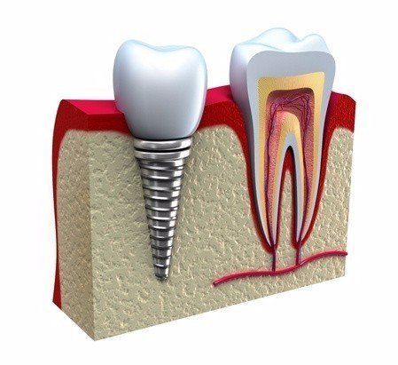 tooth implant
