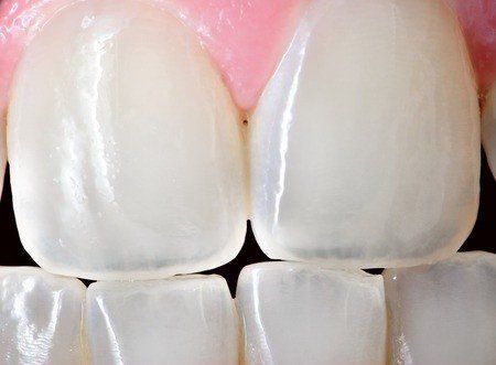 cracked tooth syndrome