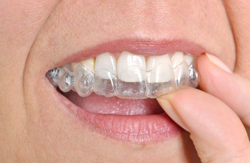 invisalign, clear correct