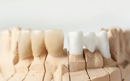dental bridge, bridges, dental care