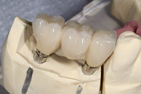 dental implants