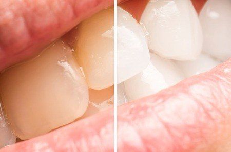teeth whitening