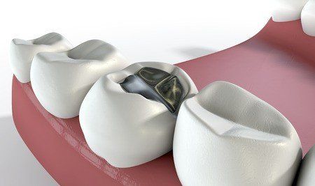 fillings, cavities, dental pain