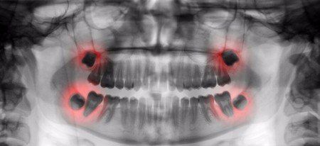 wisdom teeth