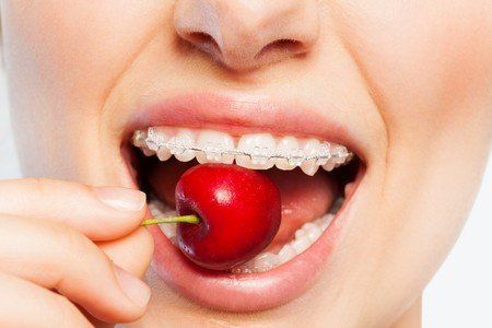 getting braces off, caring for braces, braces
