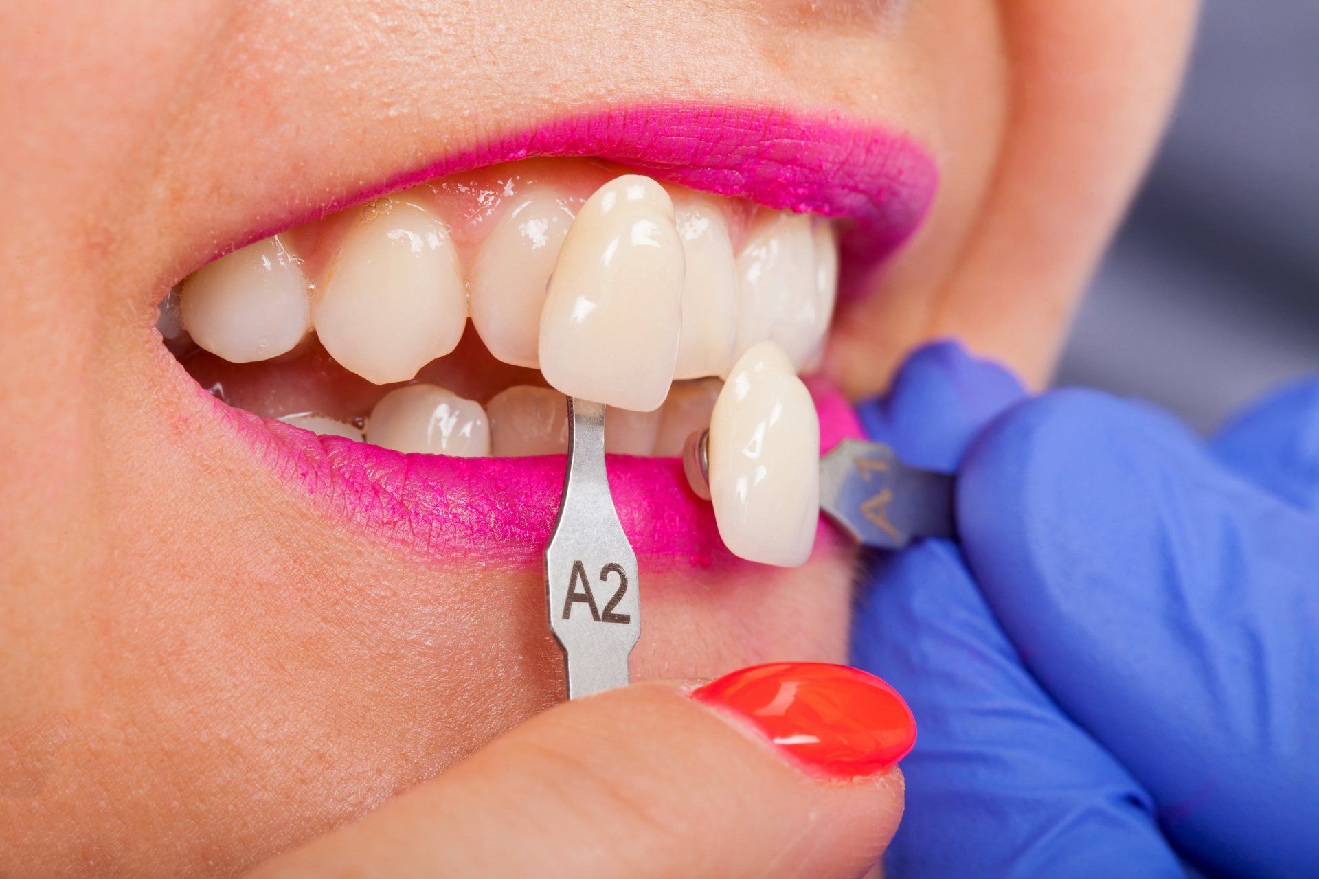 Dental veneers being applied