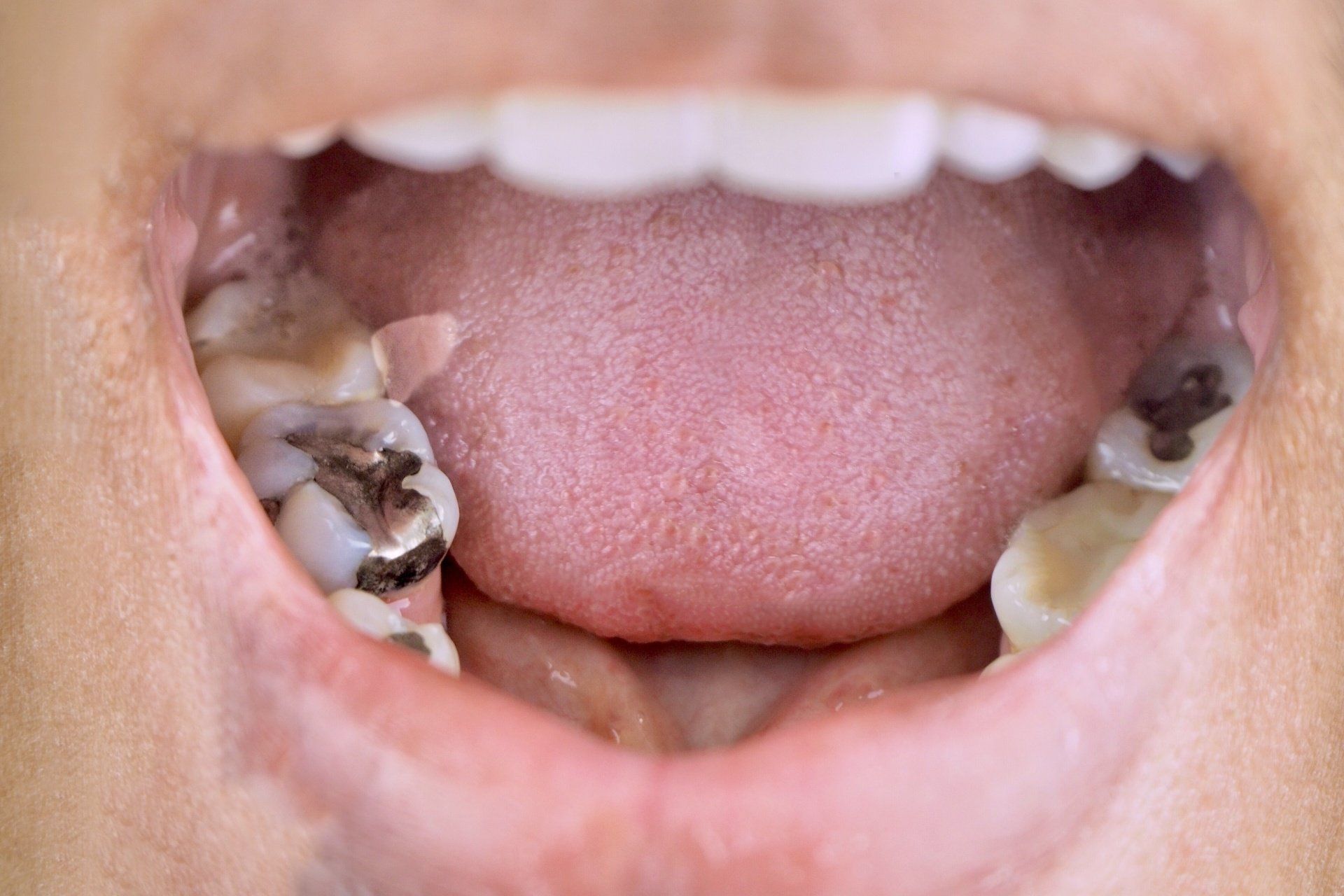 photo of old fillings