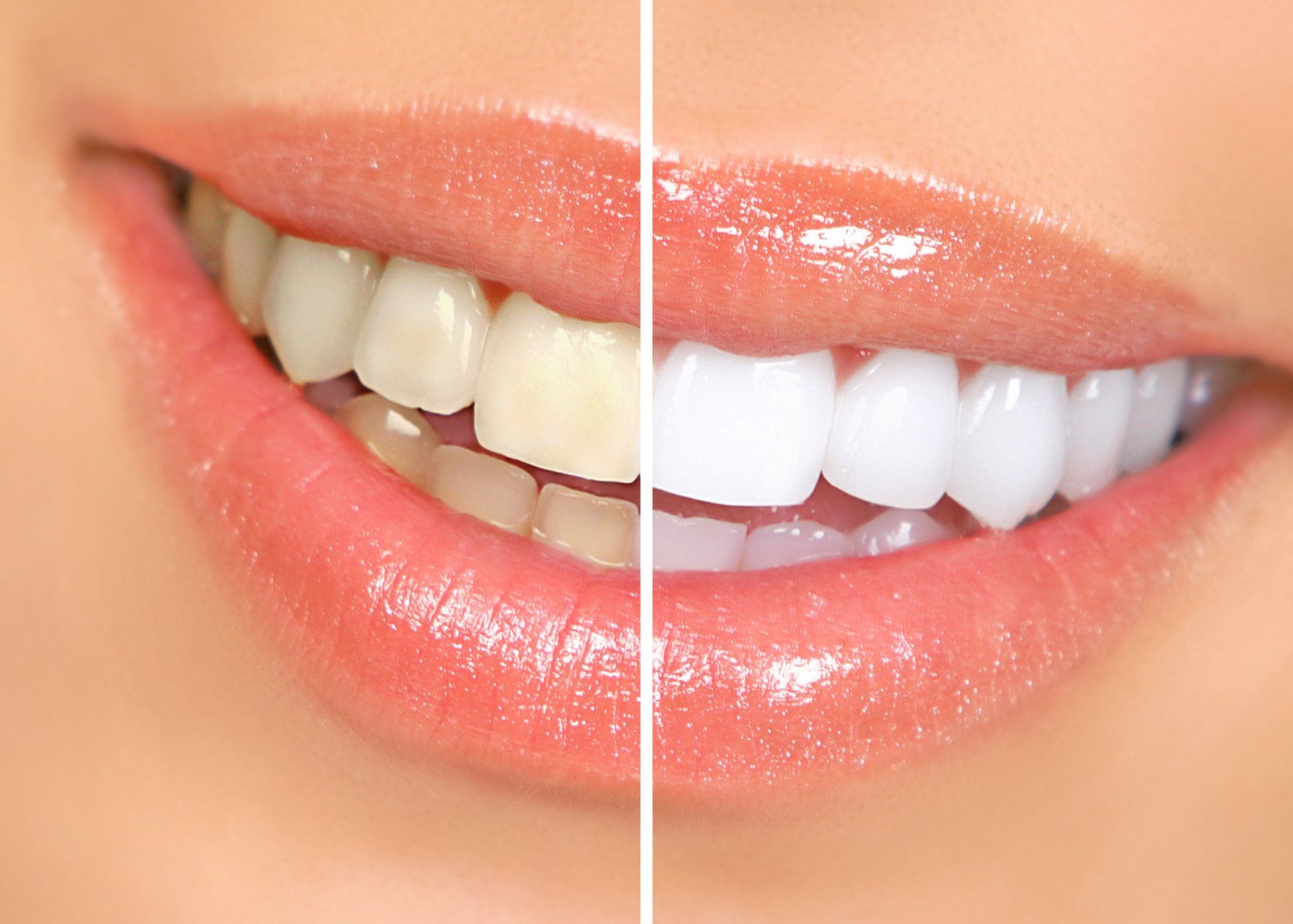 tooth whitening before and after photo