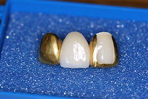 gold teeth