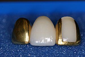 gold teeth