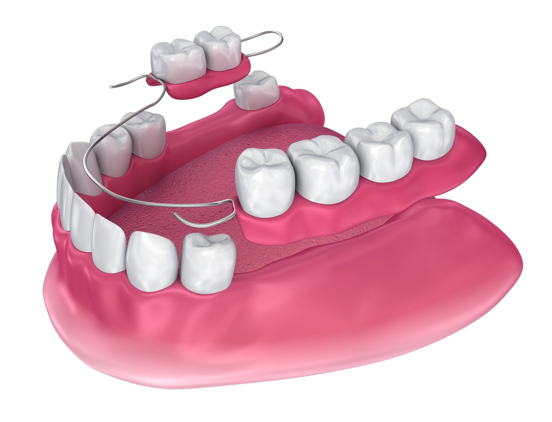 Eagle Ridge Dentures | Fort McMurray Denturist | Partial Dentures | Set Of Dentures | Flexible Dentures | Fake Teeth | Removable Teeth | Replace A Missing Tooth | Valplast Dentures