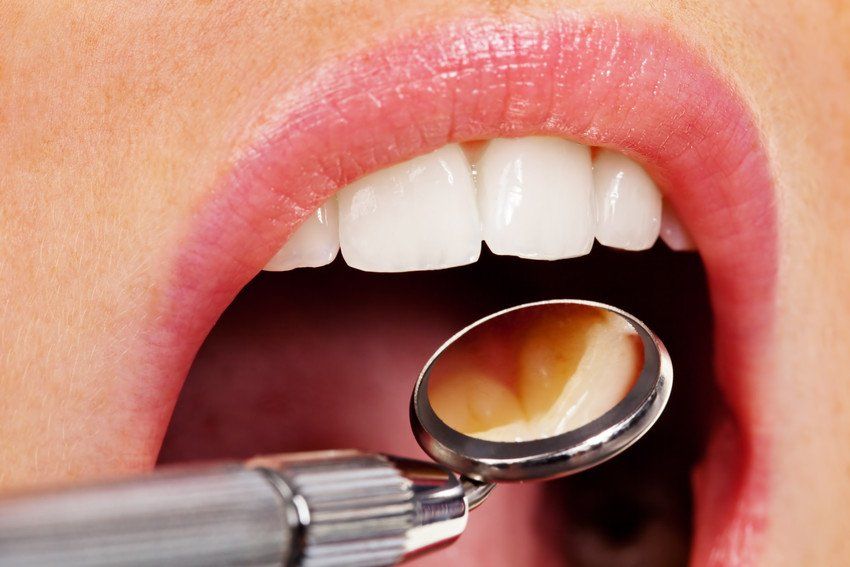 Dental crowns