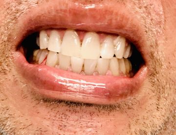 A close-up view of a person's mouth showing teeth with the lower lip pulled down, revealing gum tissue and dental alignment.