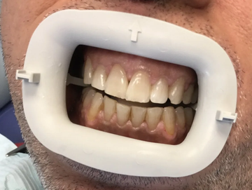 A person wearing a white plastic mouth retractor, revealing their teeth for a dental procedure.