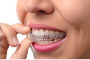 A person's hand placing a clear, plastic orthodontic aligner tray over their teeth.