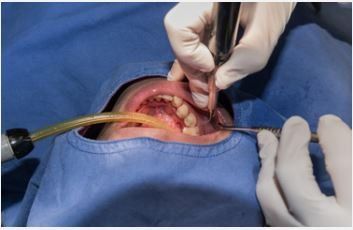 A gloved dentist performs a procedure in a patient's mouth, using a dental tool and suction, with a blue surgical drape.