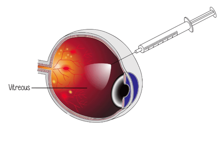 Intravitreal Injection