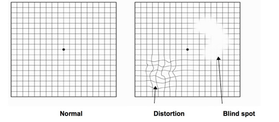 Macular Degeneration