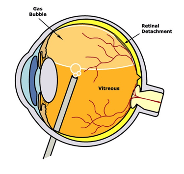 Pneumatic Retinopexy
