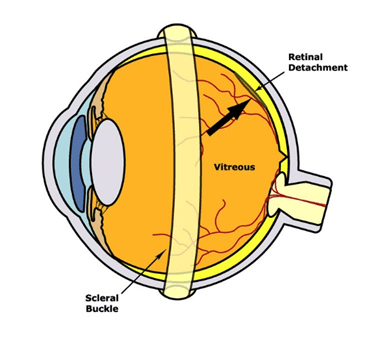 Scleral Buckle