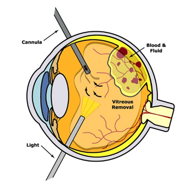 Vitrectomy