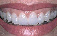 Smile 6