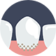 Veneers, Dentures