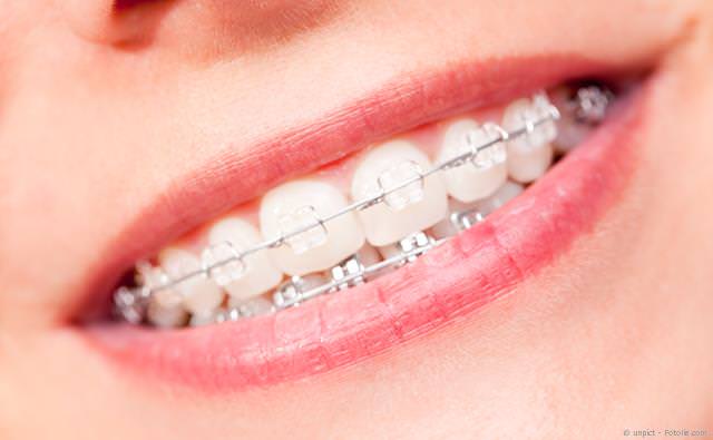 Transparente und weniger auffällige Brackets