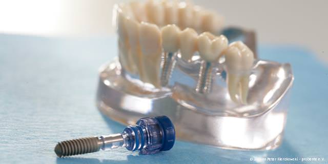 Zertifizierte Implantate renommierter Hersteller Zertifizierte Implantate renommierter Hersteller