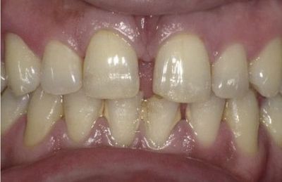 Vorher: Deutliche Lücke zwischen den oberen Schneidezähnen (sog. Diastema) Vorher: Deutliche Lücke zwischen den oberen Schneidezähnen (sog. Diastema)